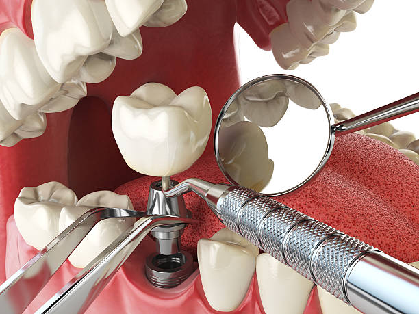 Best Dentist for Tooth Abscess  in Vinita Park, MO